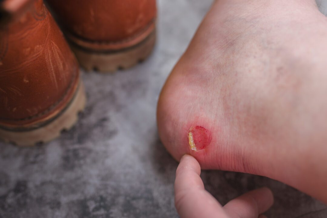 a rubbed blister on the heel of the foot.